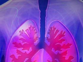 晚期肺癌有效个案:新抗原纳米疫苗为基础的综合免疫治疗+放疗