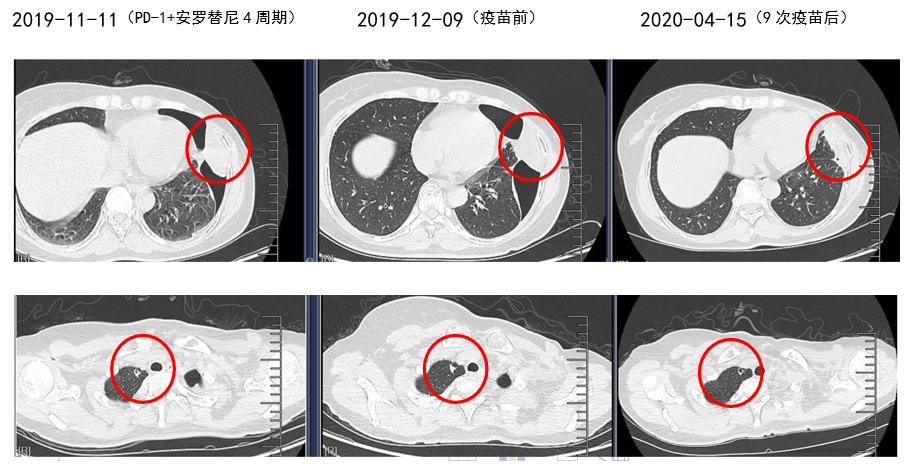 乳腺梭形细胞肉瘤：新抗原肽纳米疫苗为基础的综合免疫治疗达病理完全缓解