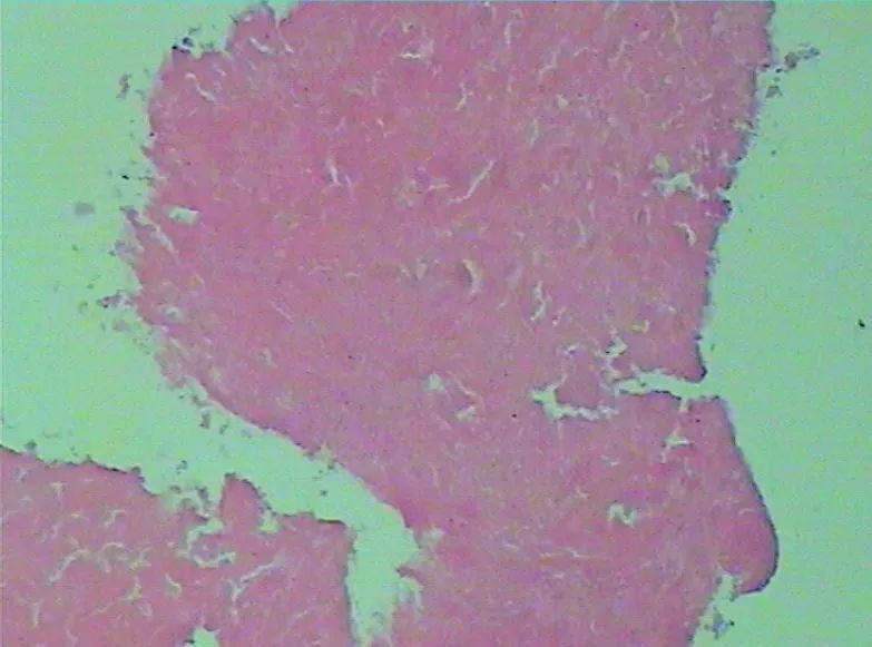 乳腺梭形细胞肉瘤：新抗原肽纳米疫苗为基础的综合免疫治疗达病理完全缓解