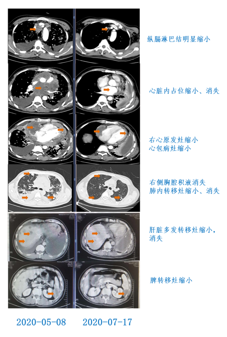 晚期心脏血管内膜肉瘤:Chemo-free的免疫综合治疗新模式达到显著缓解! 晚期心脏血管内膜肉瘤:Chemo-free的免疫综合治疗新模式达到显著缓解!