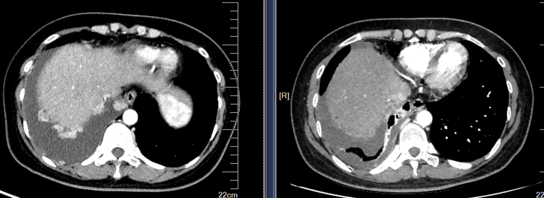 病例分享：晚期宫颈腺癌的免疫整合治疗-谁的作用？