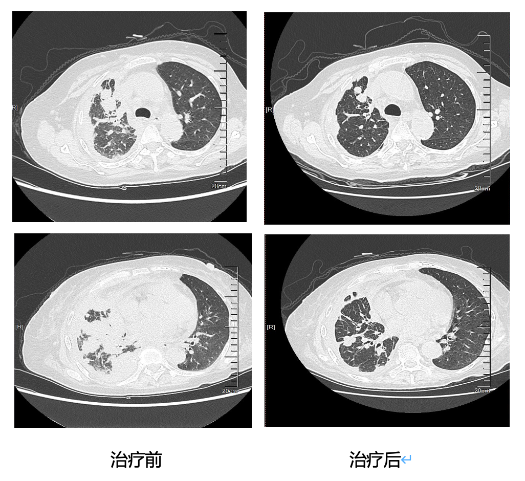 肺腺癌IV期的免疫整合治疗方式：CAP方案原理介绍与病例分享