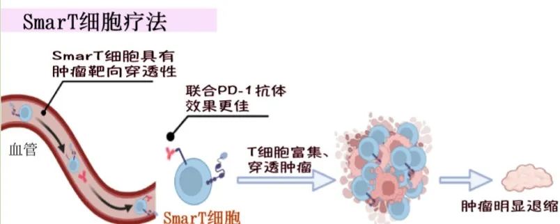 晚期胃癌一线治疗新技术：SmarT细胞联合治疗病例分享（晚期胃癌初治患者招募）