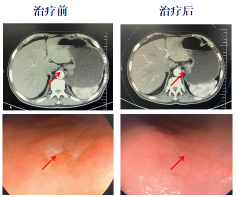 病例分享:局部给予PD-1抗体+VEGF抗体治疗一例伴心力衰竭晚期胃癌患者 病例分享:局部给予PD-1抗体+VEGF抗体治疗一例伴心力衰竭晚期胃癌患者