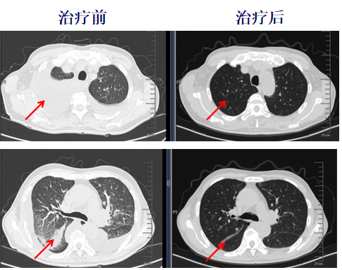 病例分享:局部给予PD-1抗体+VEGF抗体治疗一例伴心力衰竭晚期胃癌患者 病例分享:局部给予PD-1抗体+VEGF抗体治疗一例伴心力衰竭晚期胃癌患者