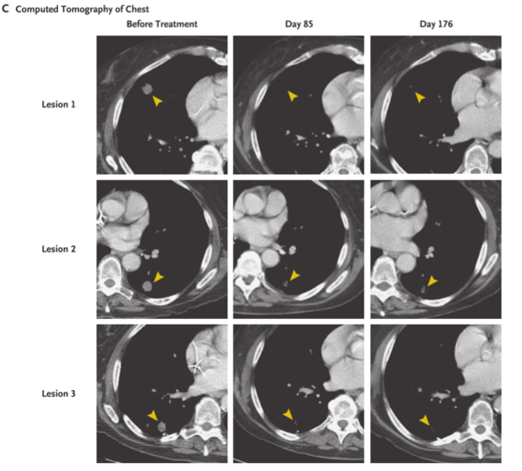 NEJM病例:靶向KRAS G12D突变的TCR-T细胞治疗转移性胰腺癌 NEJM病例:靶向KRAS G12D突变的TCR-T细胞治疗转移性胰腺癌