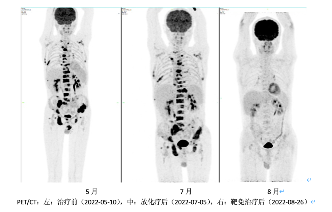 原发灶不明罕见低分化癌：安罗替尼+PD-1抗体出现奇迹般疗效一例