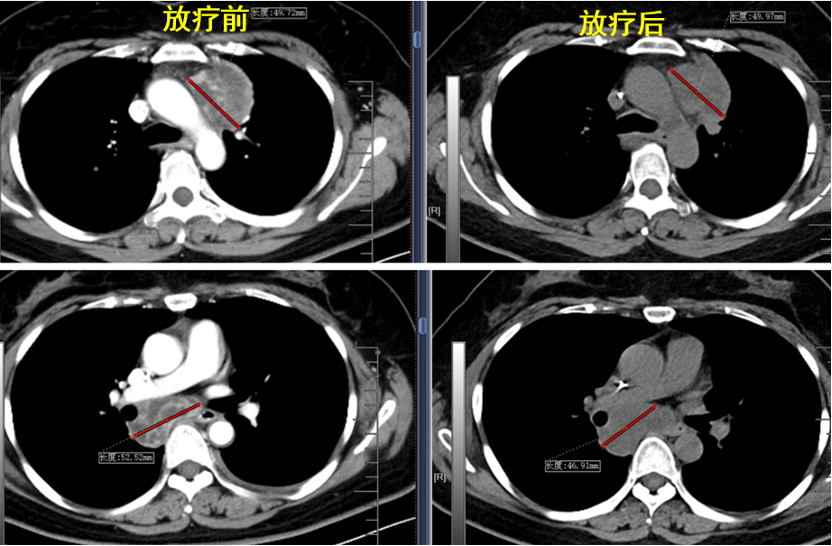 “R-ISV-FOLACTIS”新型复合原位疫苗技术使晚期滑膜肉瘤患者显著获益 “R-ISV-FOLACTIS”新型复合原位疫苗技术使晚期滑膜肉瘤患者显著获益