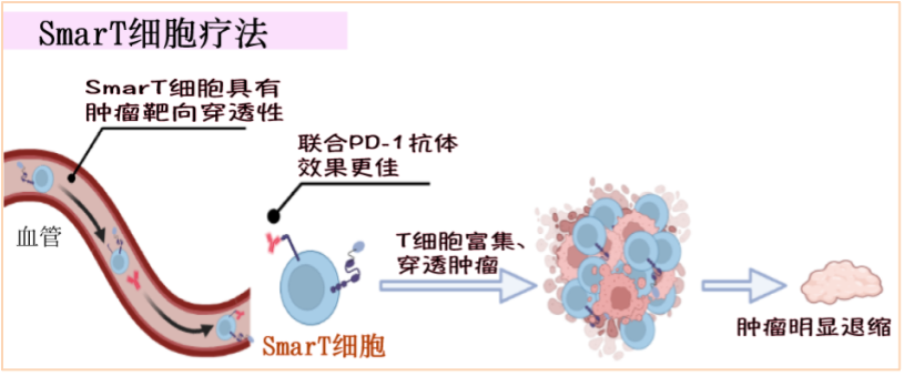 病例分享：晚期胃癌一线采用SmarT细胞联合治疗获得完全缓解